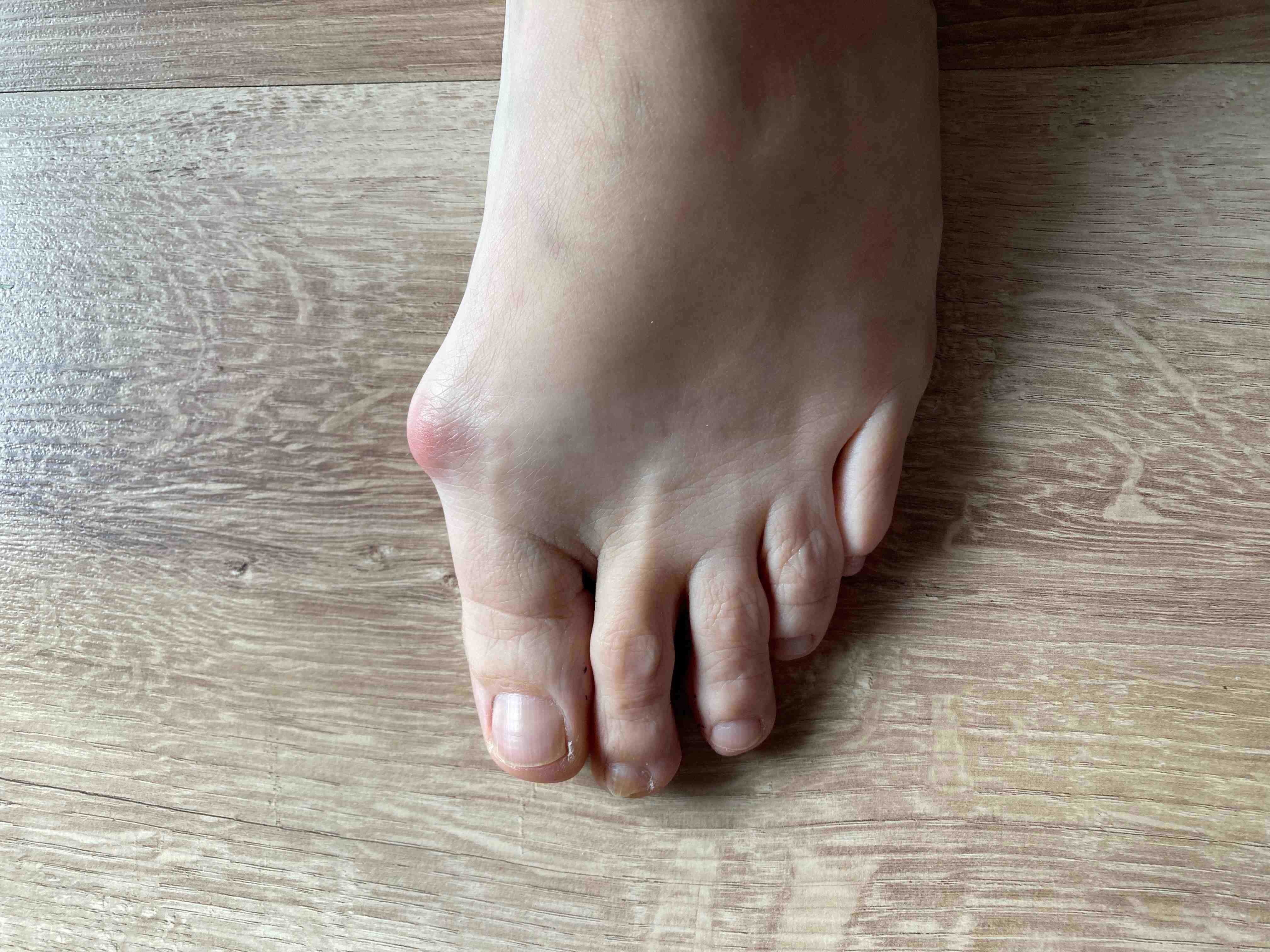 hallux valgus